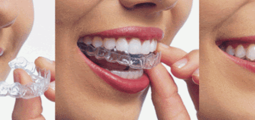 Dental Braces