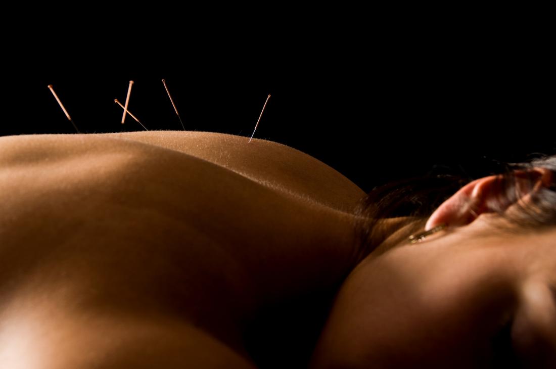 Acupuncture Treatment